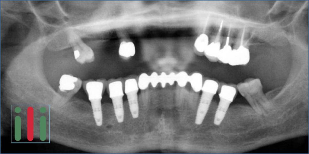 Problems with One-phase Implants - What Can Go Wrong