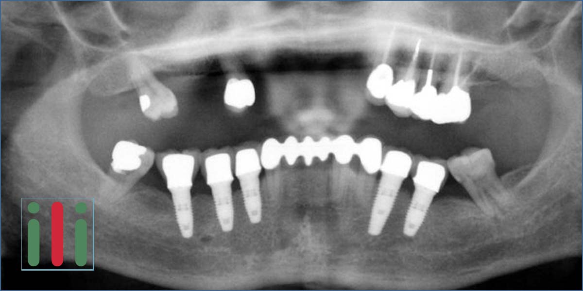 Problems with One-phase Implants - What Can Go Wrong