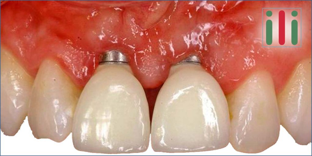 Dental Metal Allergy