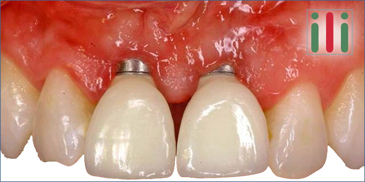 Dental Metal Allergy