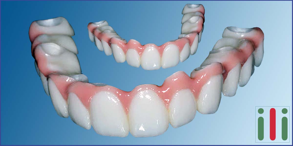 Advantages of one-Phase Implant - Dental Implantation