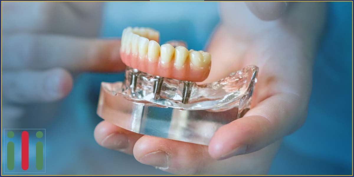 Fogbeültetés - Implantátum Beültetés