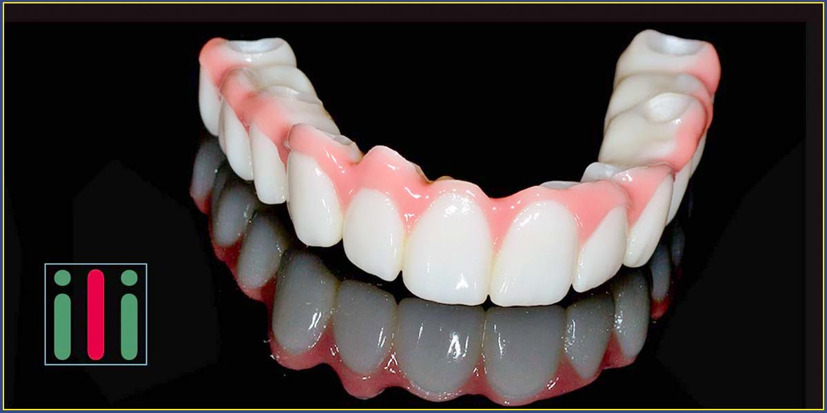 Fogbeültetés Fogászati Implantátummal, Garanciával