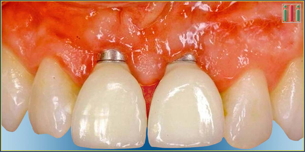 Lehetséges Probléma Kétfázisú Implantátummal - Megoldások