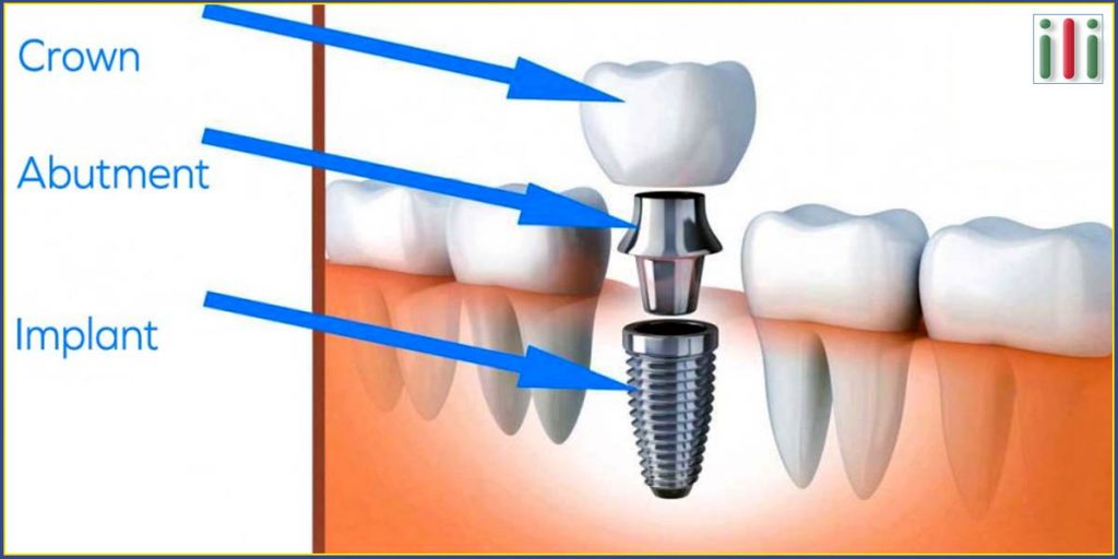 Two-phase Implants the Traditional implantation Method