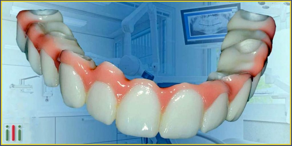 Gyors implantátum beültetés - Azonnal terhelhető implantátum