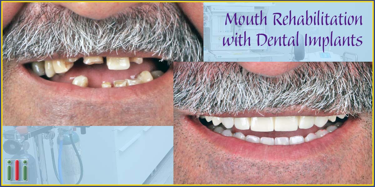 Mouth rehabilitation with dental implants