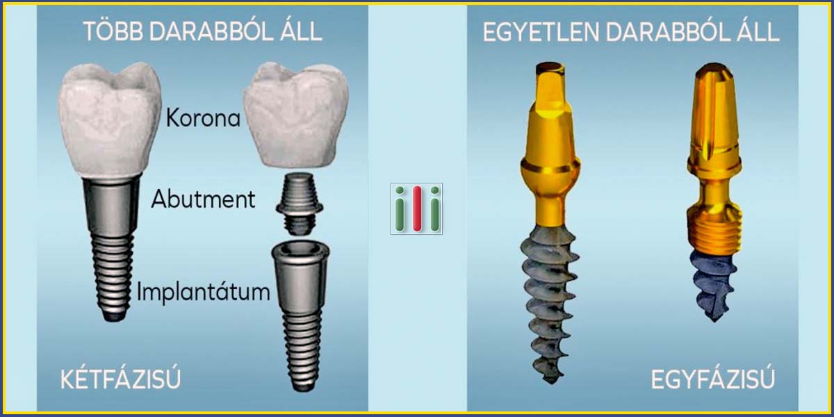 Fogászati implantátum családok és beültetési módszerek, különbségek a kétfázisú és az egyfázisú implantátum között.