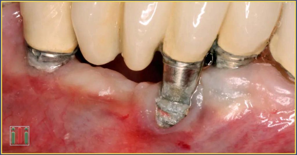 Possible problems with dental implants - What are the most common