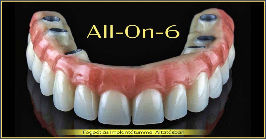 All-on-6 Teljes fogsor hat implantátummal